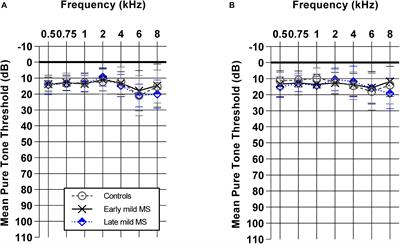 Speech Discrimination Tasks: A Sensitive Sensory and Cognitive Measure in Early and Mild Multiple Sclerosis